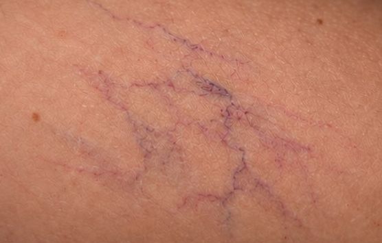 Pele da perna com micro vasinhos arroxeados, antes do tratamento