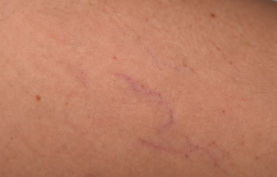 A mesma área da perna depois do tratamento, com os vasinhos mais claros