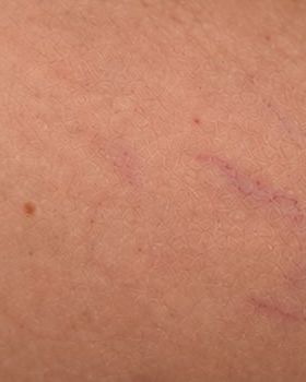 Pele com micro vasinhos bem clarinhos depois do tratamento